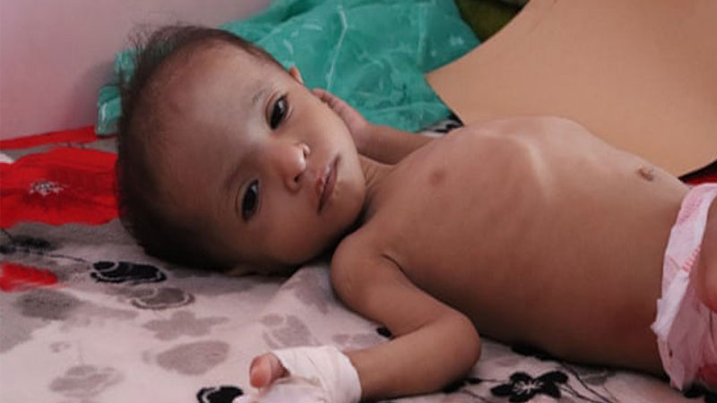 children acute malnutrition